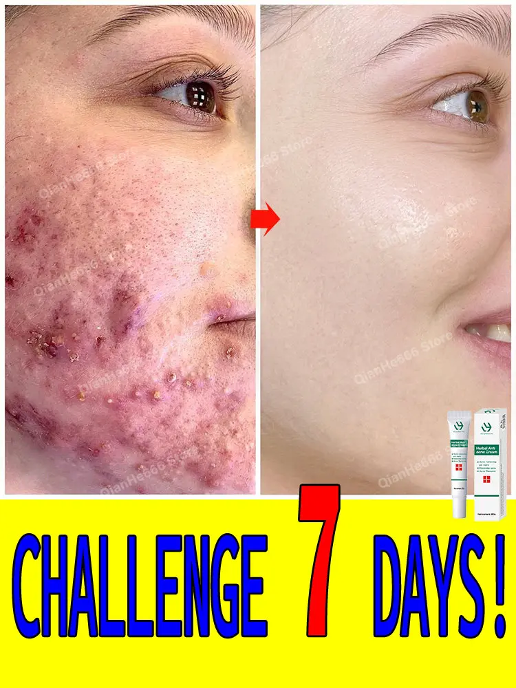 Oil Control Acne Cream Treat Acne Scars Eliminate Acne Shrink Pores Whitening Moisturizing Face Care Korea Skin Care
Oil Control Acne Cream Treat Acne Scars Eliminate Acne Shrink Pores Whitening Moisturizing Face Care Korea Skin Care
