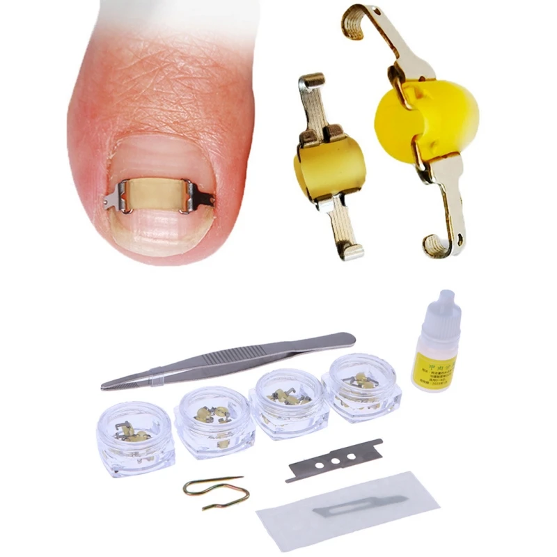 Ingrown Toenail Corrector Tools Pedicure Professional Ingrown Toenail Correction Foot Care Tool Recover Embed Toe Nail Treatment
Ingrown Toenail Corrector Tools Pedicure Professional Ingrown Toenail Correction Foot Care Tool Recover Embed Toe Nail Treatment