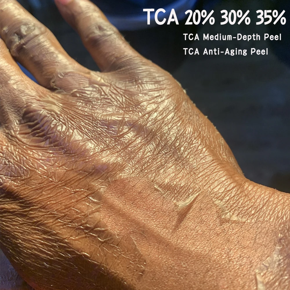 

TCA Skin Peel 20% 30% 40% sets Deep Medium-Depth Benefits Treatment for Sun Damage Rosacea Enlarged Pores