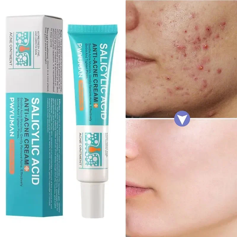 Salicylic Acid Acne Removal Cream Anti-Acne Gel Effective Treatment Pimple Spot Scar Blackhead Oil Control Moisturizer Skin Care
Salicylic Acid Acne Removal Cream Anti-Acne Gel Effective Treatment Pimple Spot Scar Blackhead Oil Control Moisturizer Skin Care