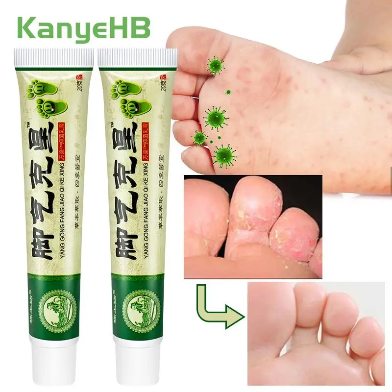 2Pcs Foot Odor Beriberi Cream Anti Fungal Infections Feet Anti-itch Treat Psoriasis Peeling Remove Tinea Pedis Herbal Cream A941
2Pcs Foot Odor Beriberi Cream Anti Fungal Infections Feet Anti-itch Treat Psoriasis Peeling Remove Tinea Pedis Herbal Cream A941