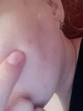 Parche para espinillas de acné, pegatinas invisibles para acné, tratamiento de imperfecciones, removedor de granos y acné, herramienta de belleza para el cuidado de la piel