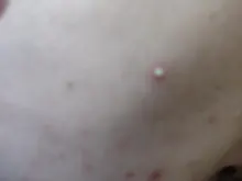 Parche para espinillas de acné, pegatinas invisibles para acné, tratamiento de imperfecciones, removedor de granos y acné, herramienta de belleza para el cuidado de la piel