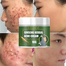 Herbal Acne Facial Cream Ginseng Effective Acne Shrink Pores Oil Control Acne Whitening Moisturize Nourish Face Skin Care Cream 
Herbal Acne Facial Cream Ginseng Effective Acne Shrink Pores Oil Control Acne Whitening Moisturize Nourish Face Skin Care Cream
