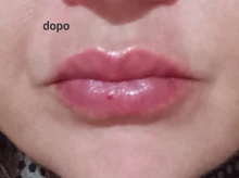 Neurami-ácido hialurónico labial, 1ml, reticulado, aumento de labios, para pluma hialurón