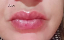 Neurami-ácido hialurónico labial, 1ml, reticulado, aumento de labios, para pluma hialurón