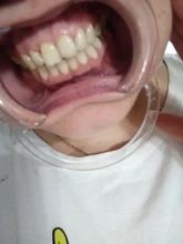 5 uds en forma de C Dental de plástico labio retractores de mejillas boca abridor instrumentos de ortodoncia dental productos limpieza Oral herramienta blanquear los dientes