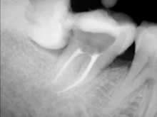 Lima de canal de raíces Dental, instrumento de Odontología de 25mm, oro, oro, endodoncia