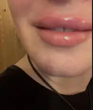 Neurami-ácido hialurónico labial, 1ml, reticulado, aumento de labios, para pluma hialurón