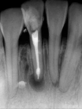 Lima de canal de raíces Dental, instrumento de Odontología de 25mm, oro, oro, endodoncia