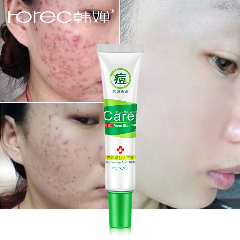 ROREC Natura Rejuvenation Moisturizing Acne Cream Anti Acne Treatment Scar Removal Gel Whitening Shrink Pores For Face Skin Care
ROREC Natura Rejuvenation Moisturizing Acne Cream Anti Acne Treatment Scar Removal Gel Whitening Shrink Pores For Face Skin Care