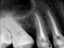 Lima de canal de raíces Dental, instrumento de Odontología de 25mm, oro, oro, endodoncia