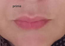 Neurami-ácido hialurónico labial, 1ml, reticulado, aumento de labios, para pluma hialurón