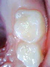 Endoscopio Dental Oral inalámbrico WiFi HD Cámara endoscopio Intraoral luz LED vídeo en tiempo Real herramienta de blanqueamiento de dientes