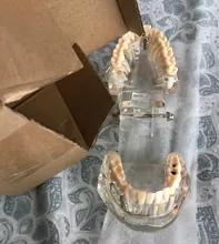 1 Uds implante Dental enfermedad dientes modelo restauración puente Diente de dentista para la ciencia médica enfermedad Dental estudio pedagógico