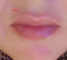 Neurami-ácido hialurónico labial, 1ml, reticulado, aumento de labios, para pluma hialurón