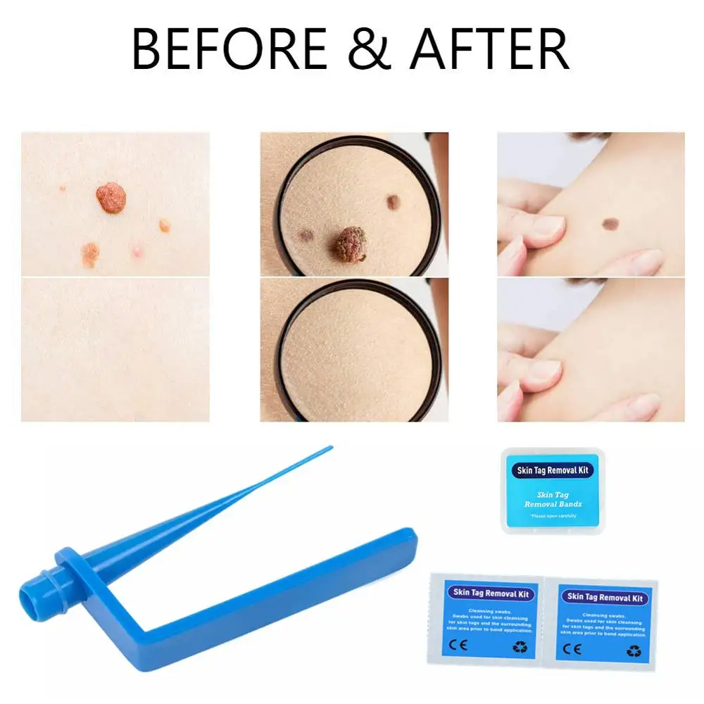 Micro Band Skin tag remover Skin Tag Removal Kit With Cleansing Swabs Mole Wart Face Skin Care Beauty Tools For Home Use
Micro Band Skin tag remover Skin Tag Removal Kit With Cleansing Swabs Mole Wart Face Skin Care Beauty Tools For Home Use