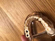 1 Uds implante Dental enfermedad dientes modelo restauración puente Diente de dentista para la ciencia médica enfermedad Dental estudio pedagógico