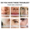 EELHOE Protein Threads Face Lift Skin Tightening Rejuvenate the Face Nourishing Deep Repair Skin Firming Protein Line Collagen 5