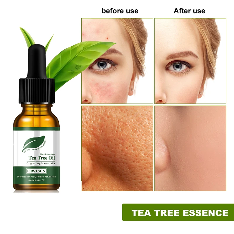 

Tea Tree Oil Facial Acne Treatment Oil Control To Pore Removal Acne Moisturizing Whitening Brightening Facial Skin Care Products
