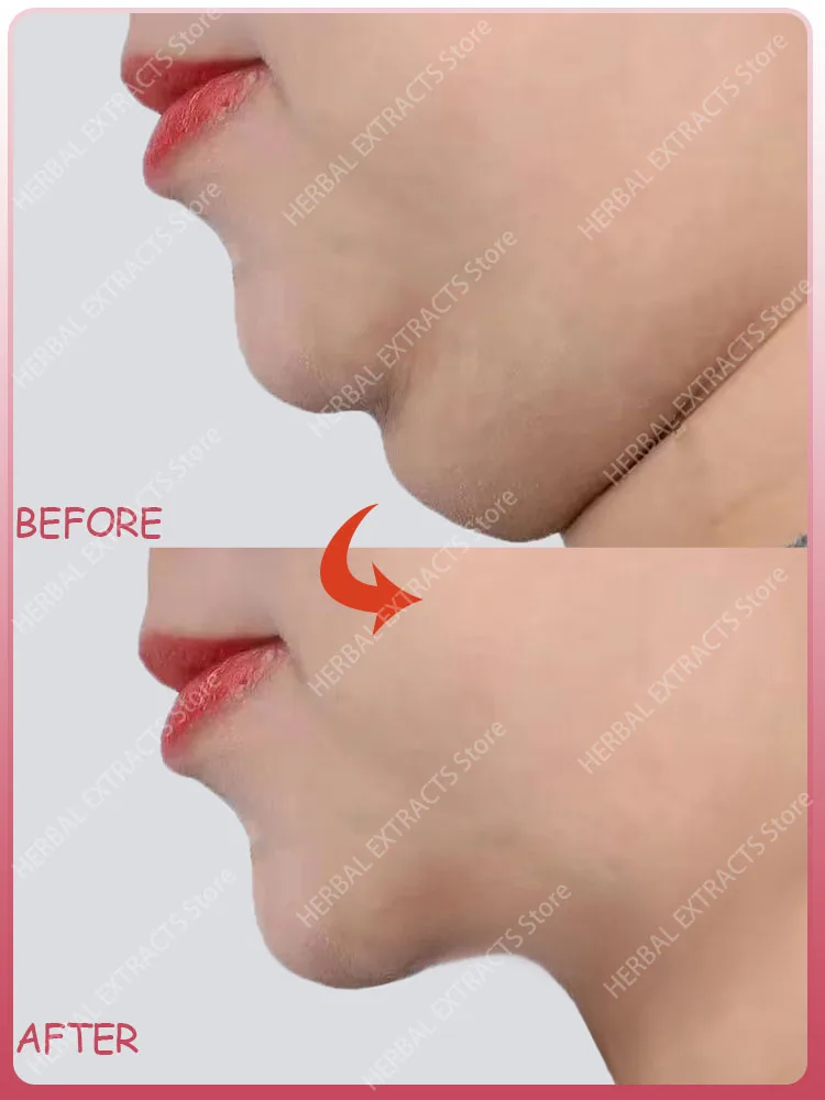 

V-Shape Firming Face-lift Slimming Cream Slimming Removal Masseter Muscle Double Chin Face Fat Burning