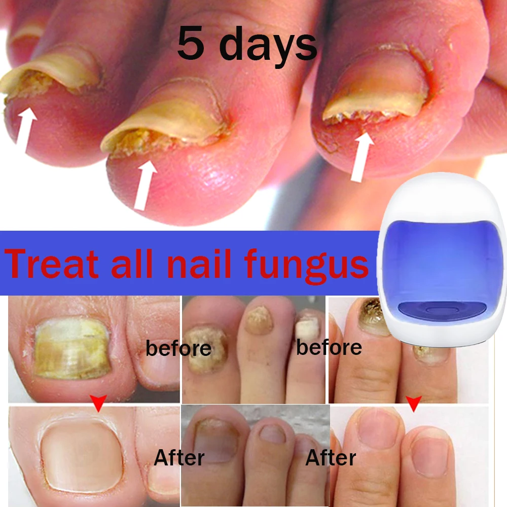 Nail Fungus Cleaning Laser Device Treatment Anti-Infective Paronychia Onychomycosis Care light-activated therapy 2020 new products toenail fungus 405nm toenail fungus treatment nail laser therapy device