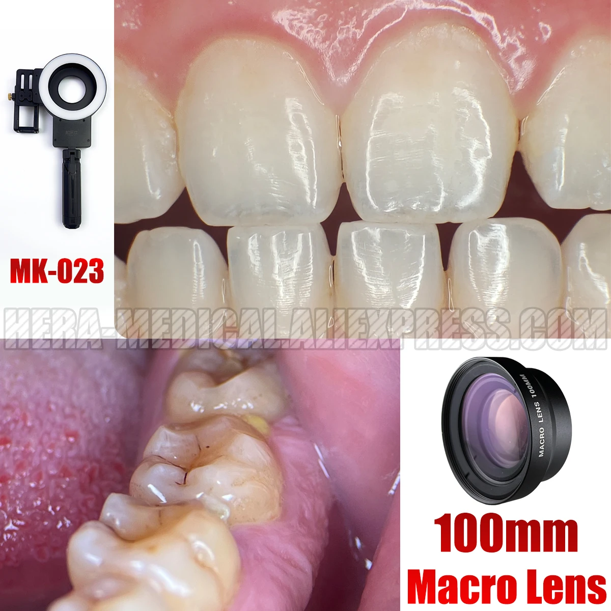 Discover 131+ ring flash for dental photography xkldase.edu.vn