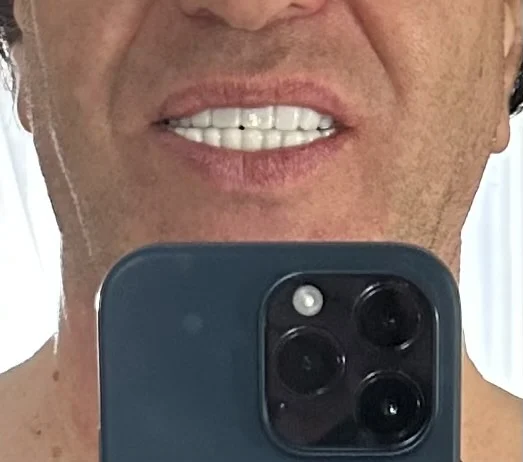 Snap On Veneers (Upper & Lower) - Top Quality Clip-On Veneers photo review