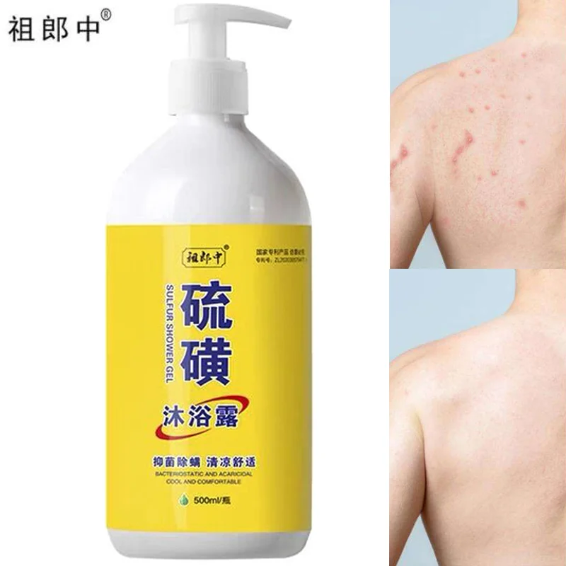 Sulfur Ointment Scabies Mites Fat Body Wash Lotion Bath Skin Care