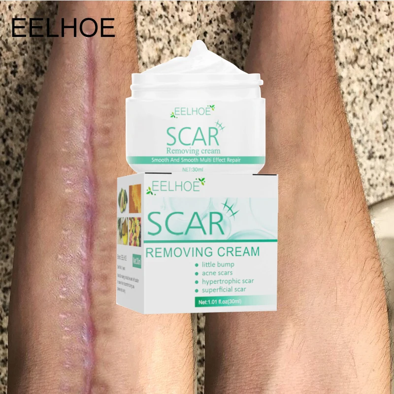 Effective Scar Removal Body Cream Treatment Pimples Stretch Marks