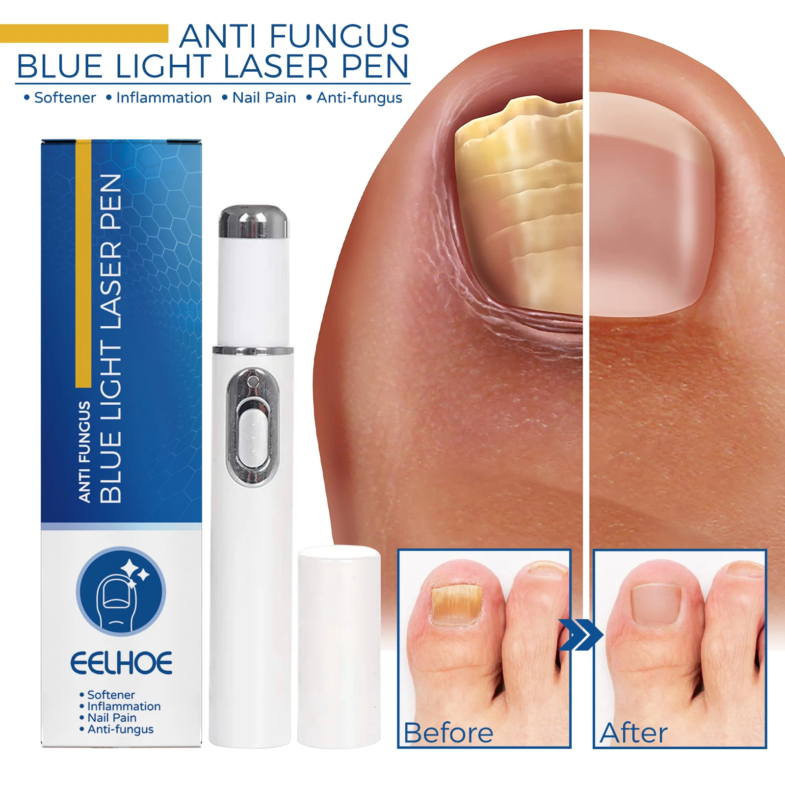 

Fungal Nail Laser Device Repair Fast Nails Fungus Onychomycosis