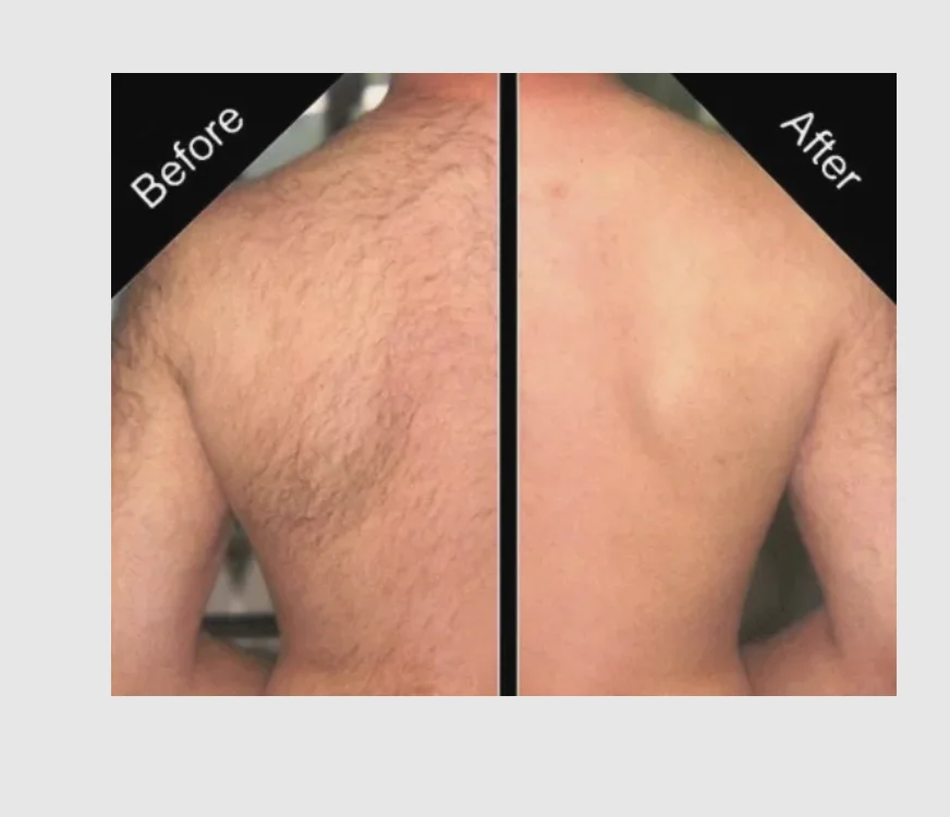 Рисунок 2 - Удаление волос муравьиное масло