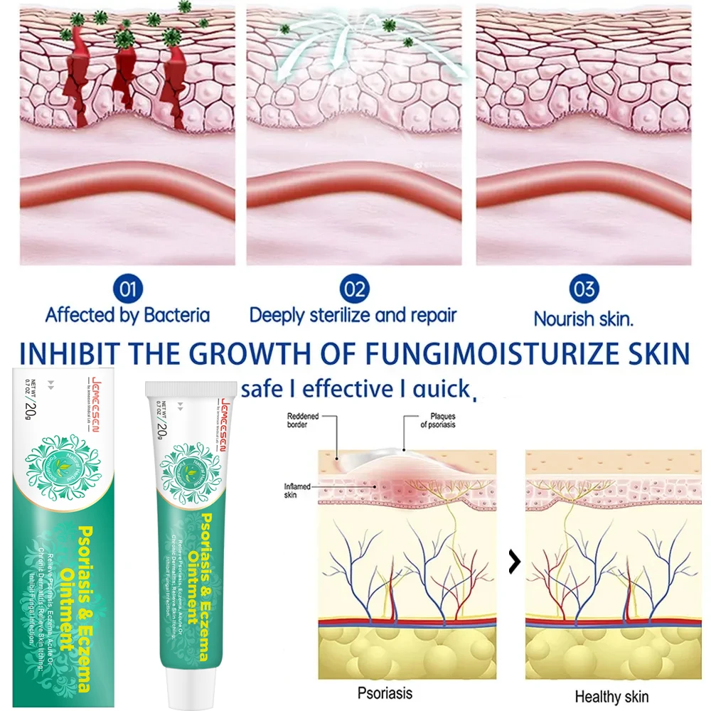 Jemeesen Psoriasis Cream Scrotum Itching Rash Dermatitis Eczema Treatment Herbal Antibiosis Ointment Tinea Pedis Inhibit Fungi psoriasis treatment cream
