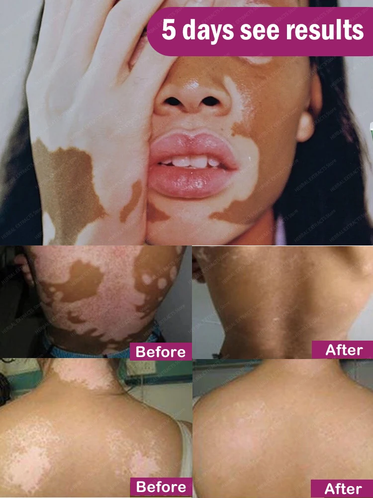 Vitiligo Repair Cream Eliminate Skin White Spot