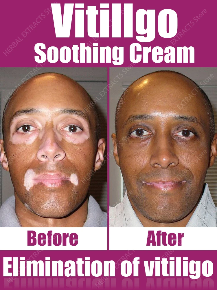 Vitiligo Repair Cream Eliminate Skin White Spot