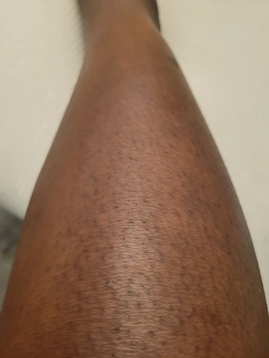 FlashDepil® – Aparelho de Depilação a Laser Portátil photo review