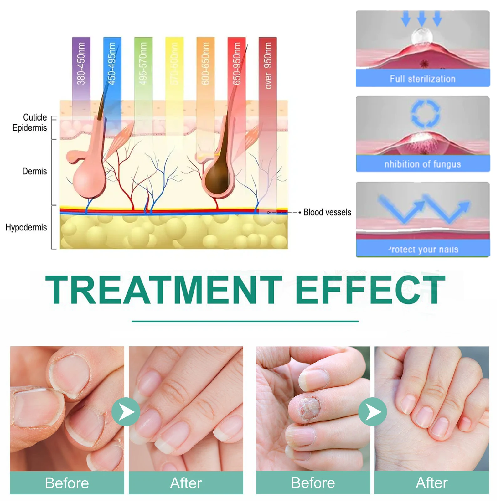 Fungal Nail Laser Device Repair Fast Nails Fungus Onychomycosis