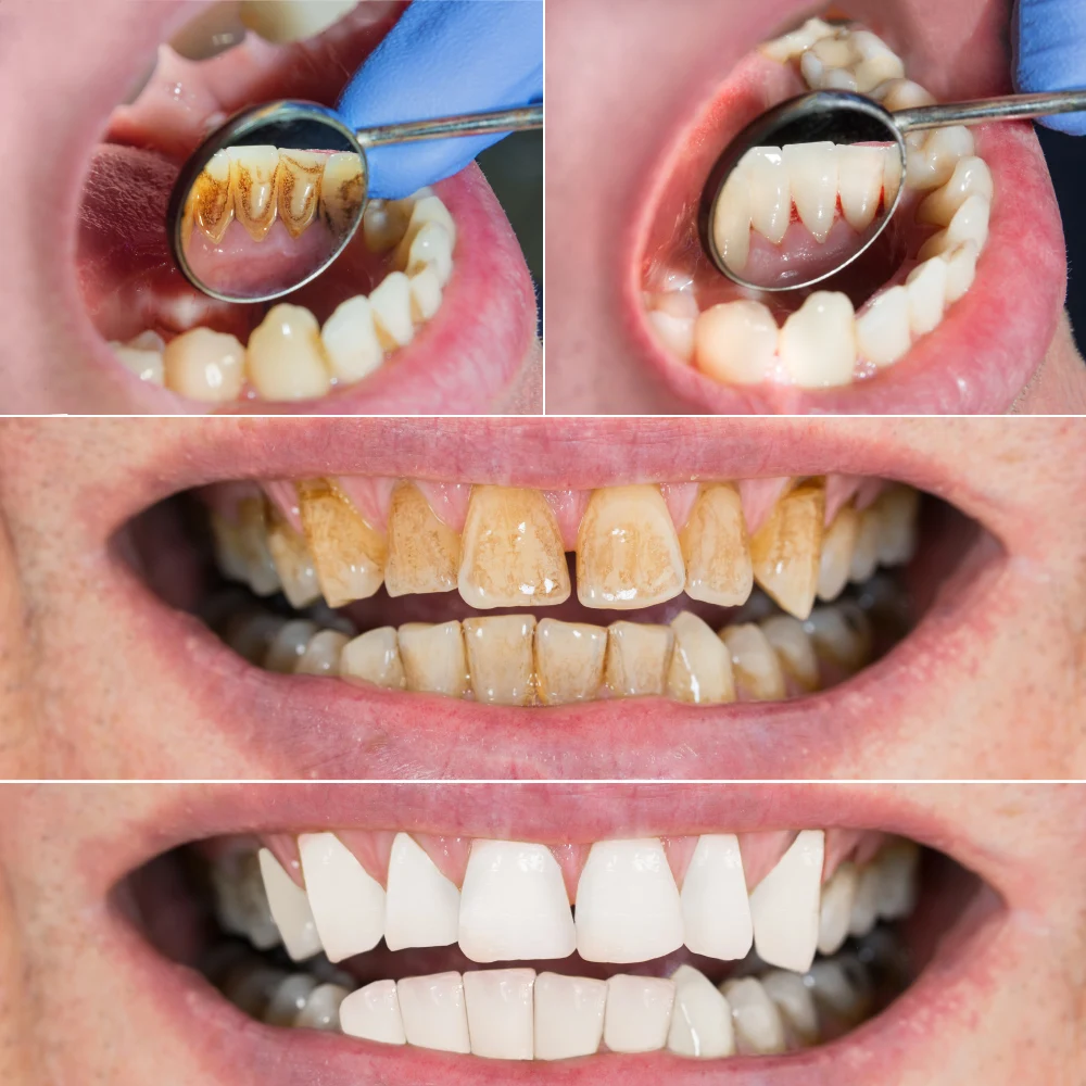 Description Picture 5 of itemUltrasonic Electric Sonic Dental Scaler Stain Tartar Calculus Remover Teeth Whitening Cleaning Waterproof Electric Toothbrush