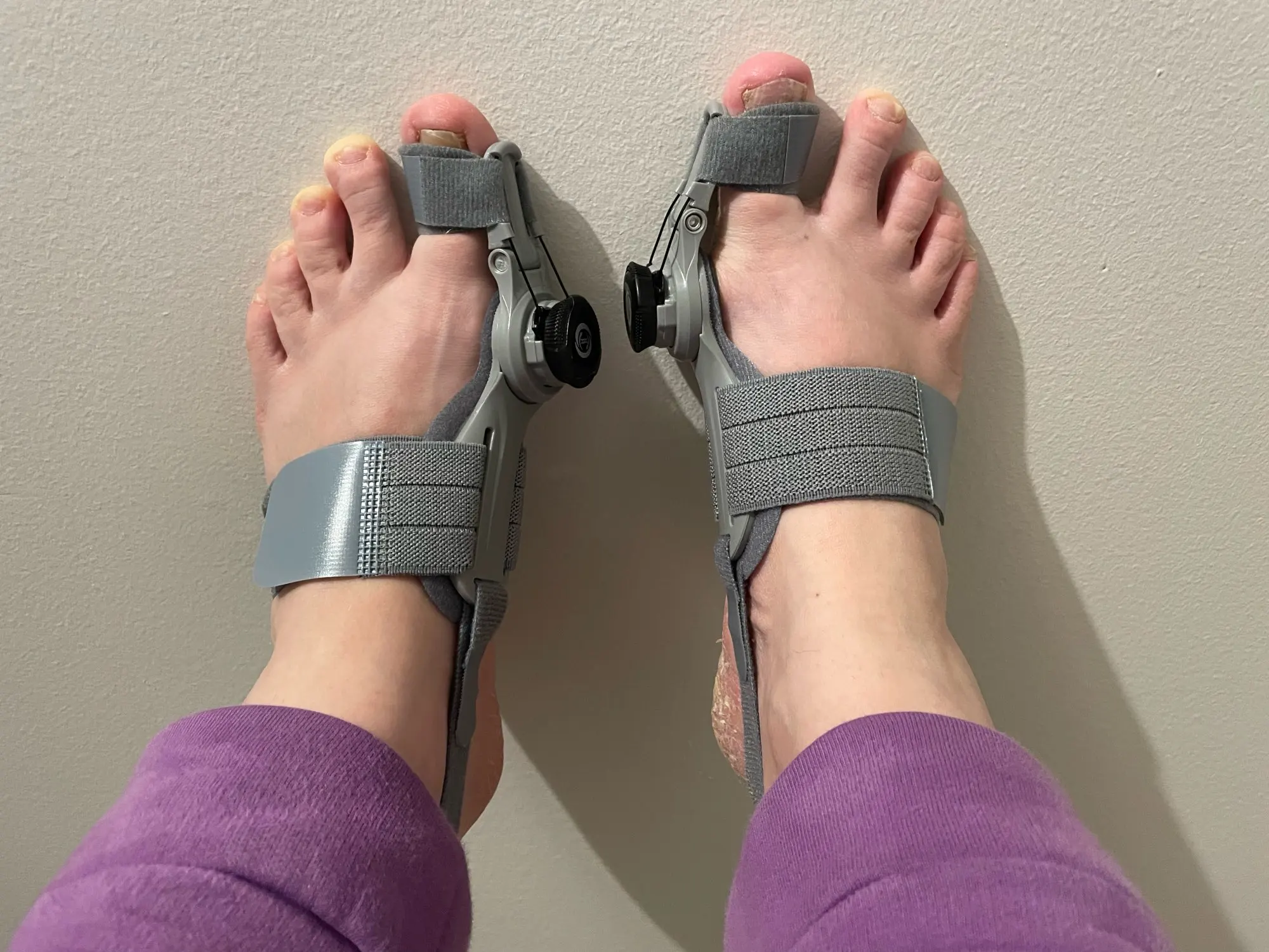 Bunion Fix Natural AtHome Bunion Relief Camicely Shop