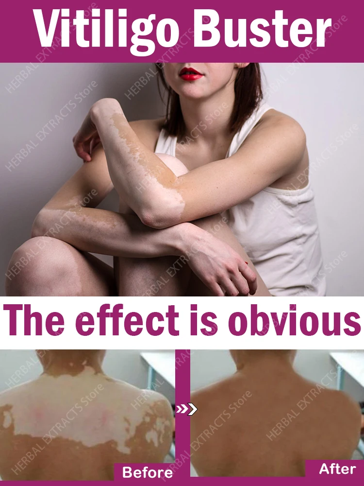 Vitiligo Repair Cream Eliminate Skin White Spot