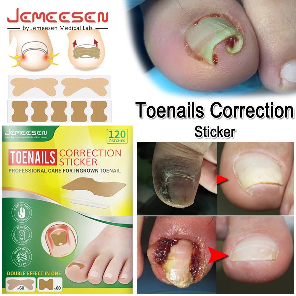 Jemeesen Ingrown Toenail Corrector Sticker Paronychia Treatment Pedicure Foot Orthodontic Toe Thumb Nail Care Patches Foot Care