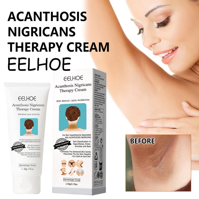 EELHOE Körperaufhellungscreme, entfernt dunkle Flecken, nährend, reduziert Stumpfheit, aufhellender Hautton, Körpercreme für Achselhöhlen-Kniegelenk