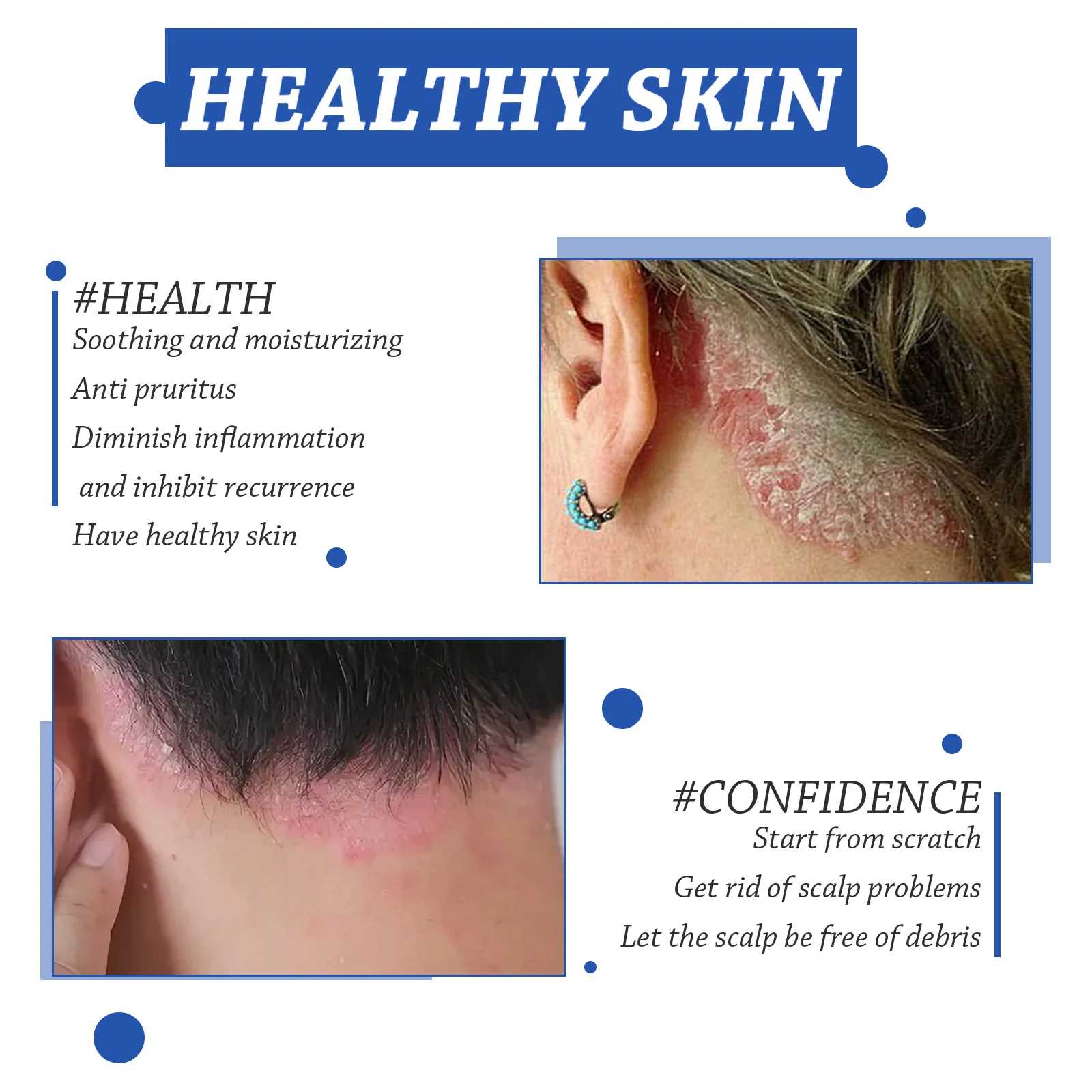 Seborrheic Dermatitis Cream Skin Care Treat Psoriasis Eczema Repair Scalp Relieve Itching Remove Dandruff Healthy Skin Ointment