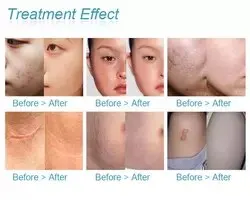 Рисунок 6 - Новейший CE Co2 Фракционный лазер/для