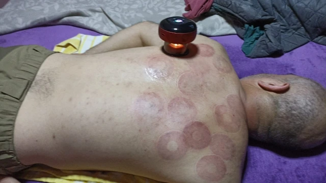 The HijaMate® | Portable Hijama Cupping Therapy & Massage Device photo review