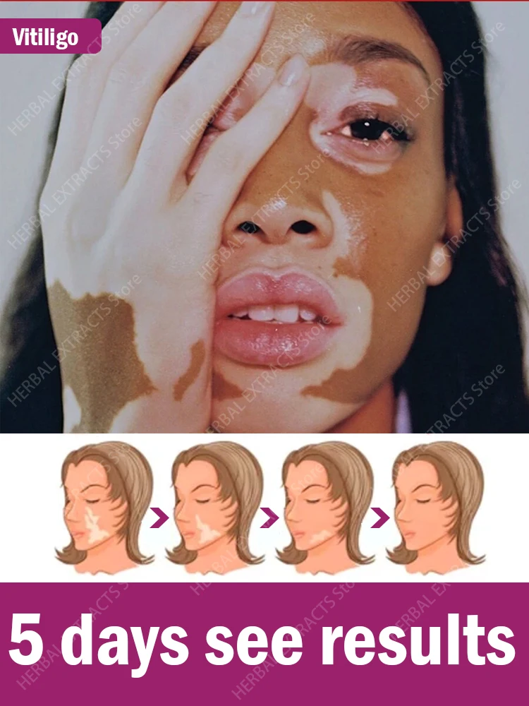 Vitiligo treatment cream White Spot Removal ointment
