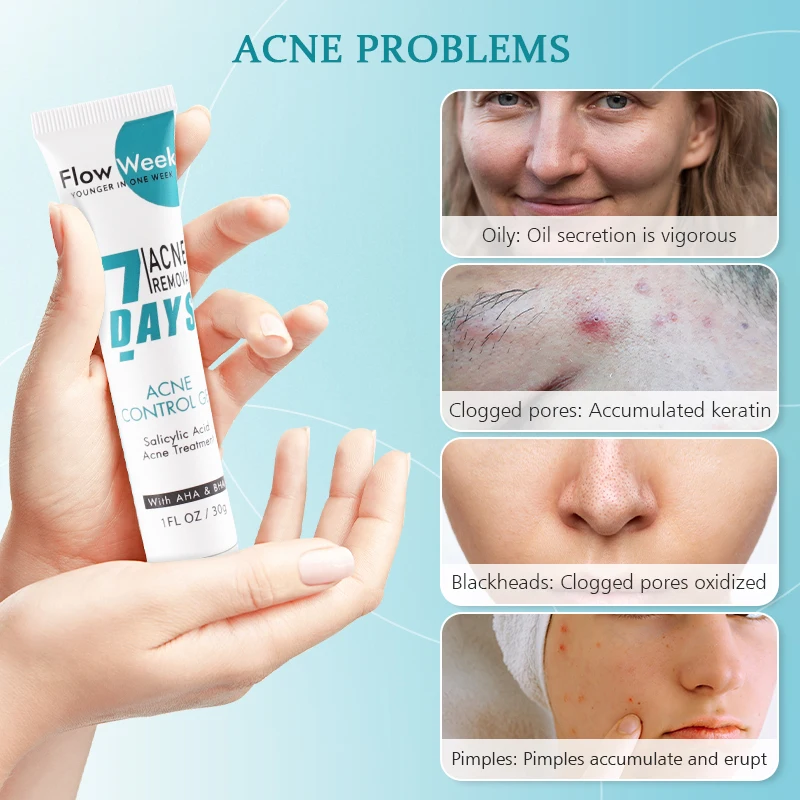 Salicylic Acid Gel Pimple Blackhead Acne Mask Dark Spot Care Shrink Pore Oily Control Skin Care