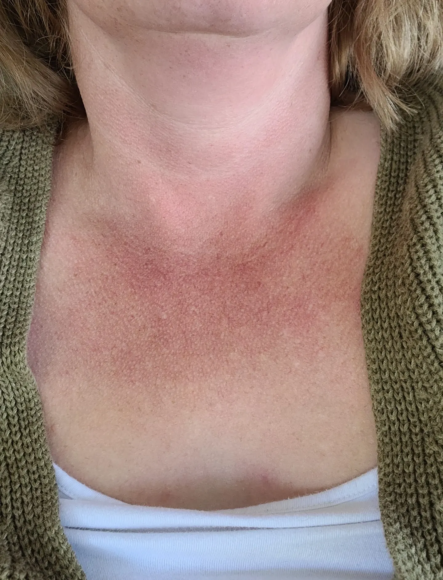 Premium Moisturizer for Rosacea UK Juhi