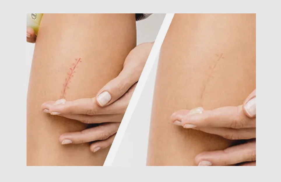 Рисунок 2 - Contractubex Крем для удаления