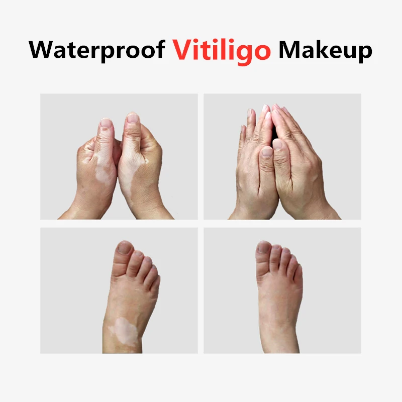 vitiligo concealer